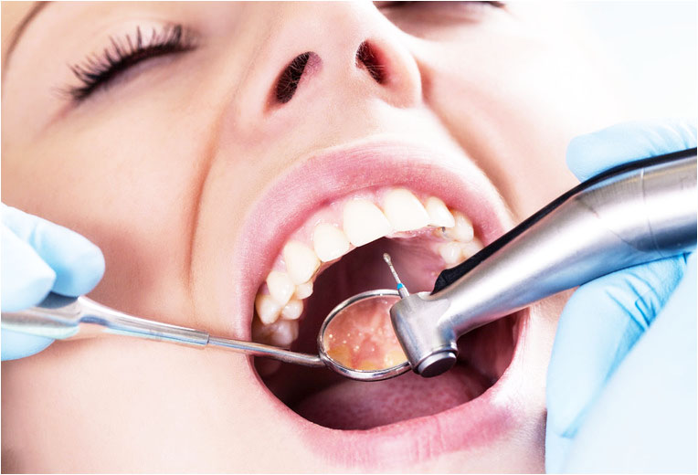 Лікування кореневих каналів зуба