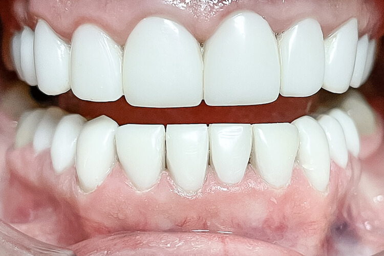 Художня реставрація зубів